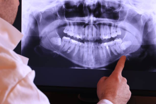 Best Dentist for Tooth Abscess  in Union City, CA